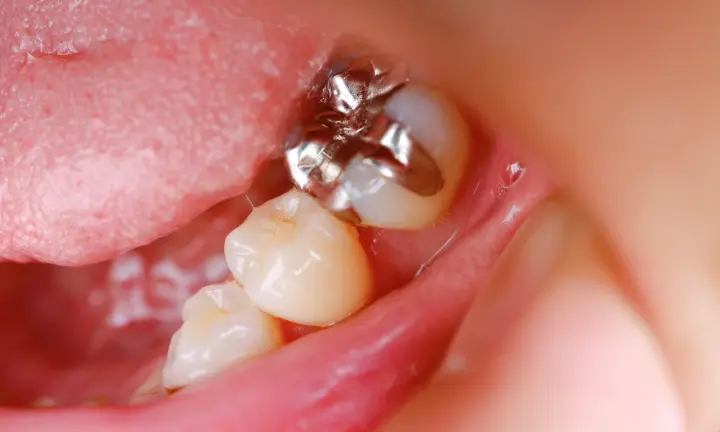 虫歯の除去・治療